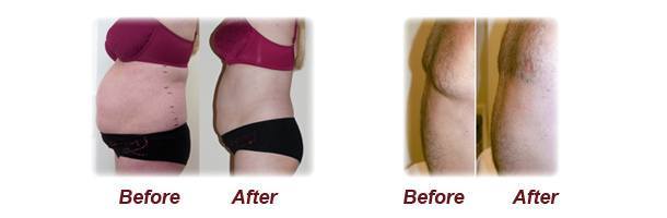 strawberry lipo 1