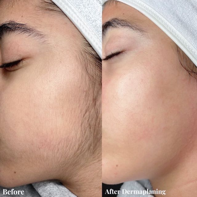 dermaplaning 1