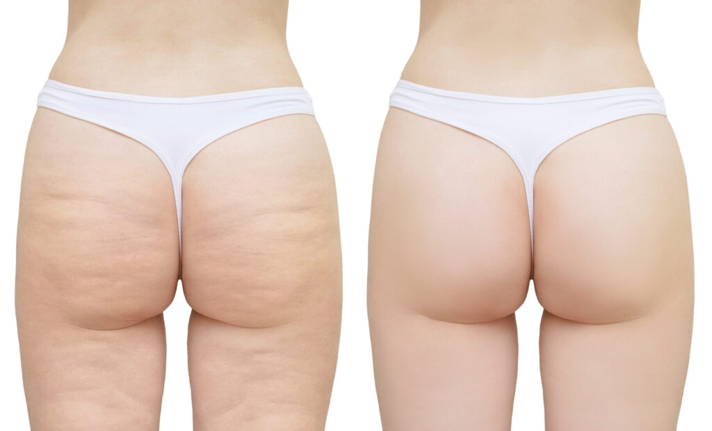 endo before and after