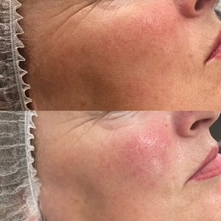 dermaplaning