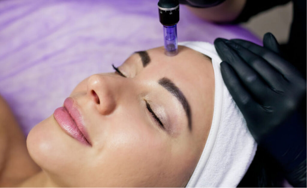 microneedling