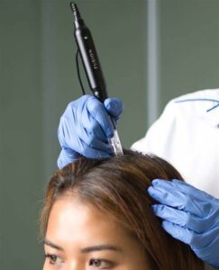microneedling hair e1692732996294